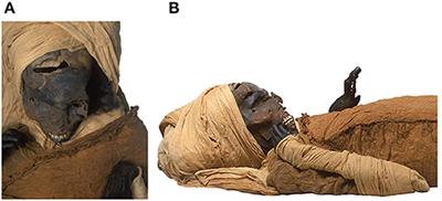 Computed Tomography Study of the Mummy of King Seqenenre Taa II: New Insights Into His Violent Death